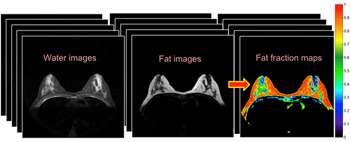 Figure. Example water and fat images reconstructed from data acquired with “fat-water method” are shown. Using the images, a parameter map can be yielded to quantitatively analyze the data sets. 